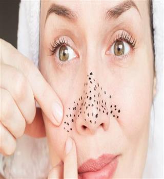 Home Remedies for Treating Blackheads