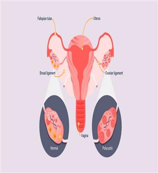 PCOS(Polycystic Ovary Syndrome)