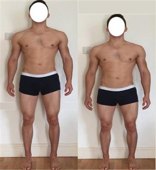 Surgery that can increase height