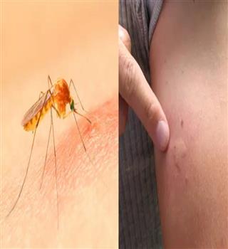 Why do mosquito bites itch?