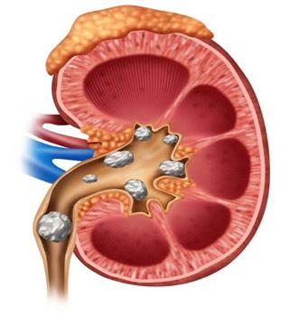What causes kidney stones?