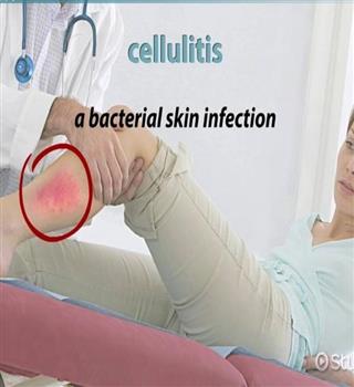 Cellulitis: What Is It?