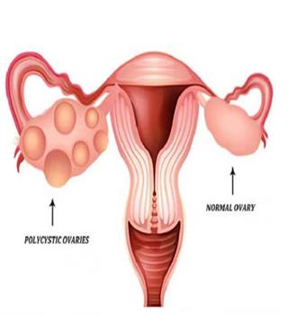 PCOD ( Polycystic Ovary Disease)