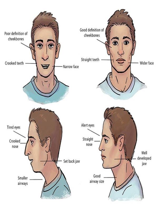 Avoid these mistakes while doing mewing - MindStick YourViews