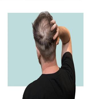 What Are The Early Signs of Balding?