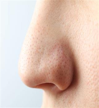 How to get rid of blackheads?