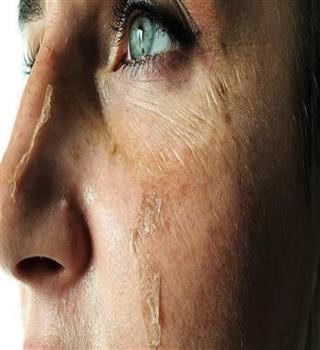 Why do we get skin peels?