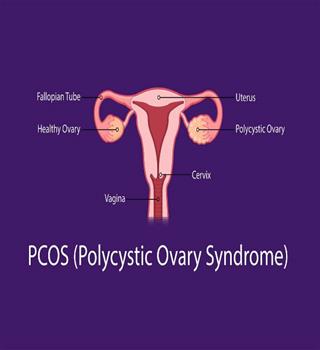 Top 8 powerful daily habits to reverse PCOS(Polycystic Ovary Syndrome)