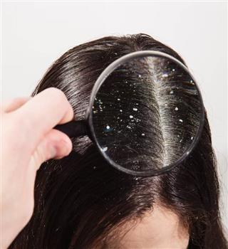 What causes dandruff?