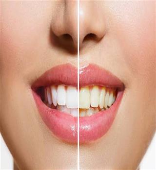 Are yellow teeth healthy?