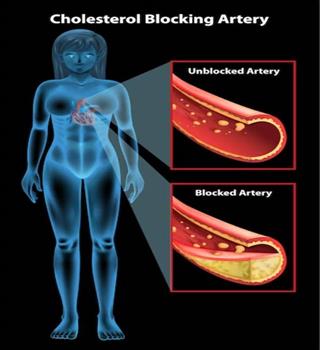 Foods that unclog arteries naturally and effectively