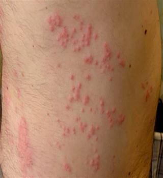 Scary sea lice cymithoa!