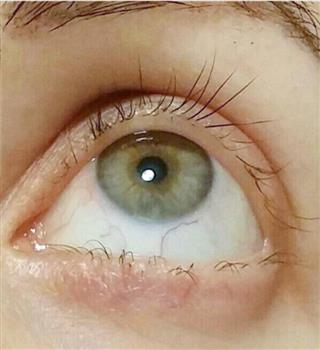 Why do eyelashes fall?