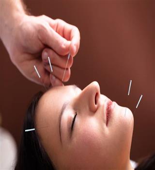 Top 10 Benefits of Acupuncture