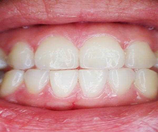 Home remedies for Pyorrhea