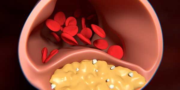 How to bring down bad cholesterol and avoid attacks