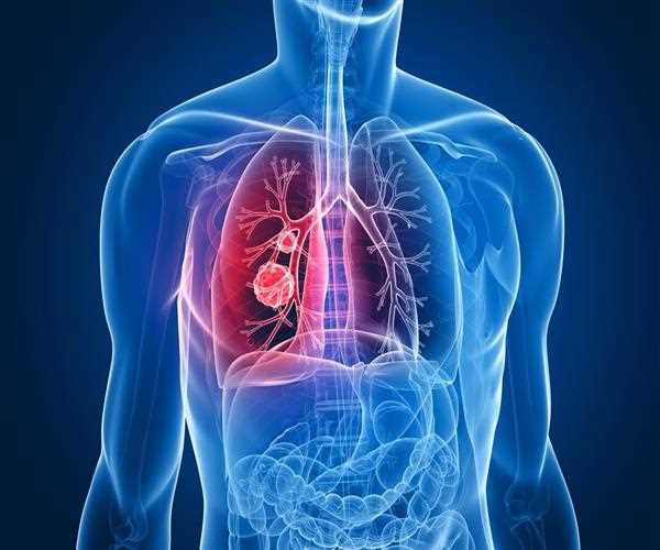 Lung Cancer, early detection, and natural herbs