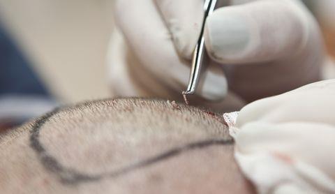 The Science of Hair Loss and Hair Transplantation