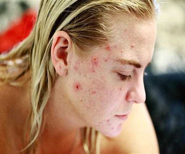 What is Period Acne and How to get rid of it?